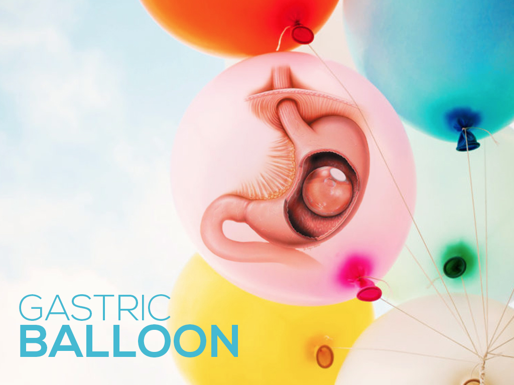In Tijuana, Mexico, a gastric balloon, also known as intragastric or stomach balloon, is a temporary and removable device to help you lose weight.