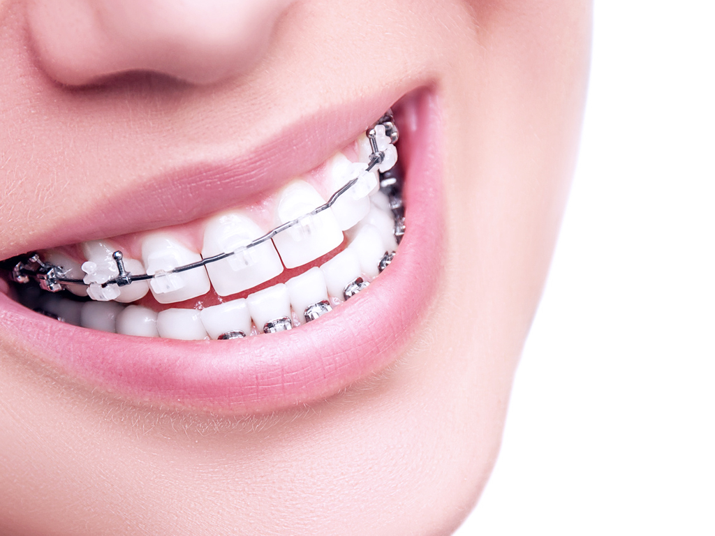 In Tijuana orthodontics is the specialist treatment that aims to correct improper bites and crooked teeth.