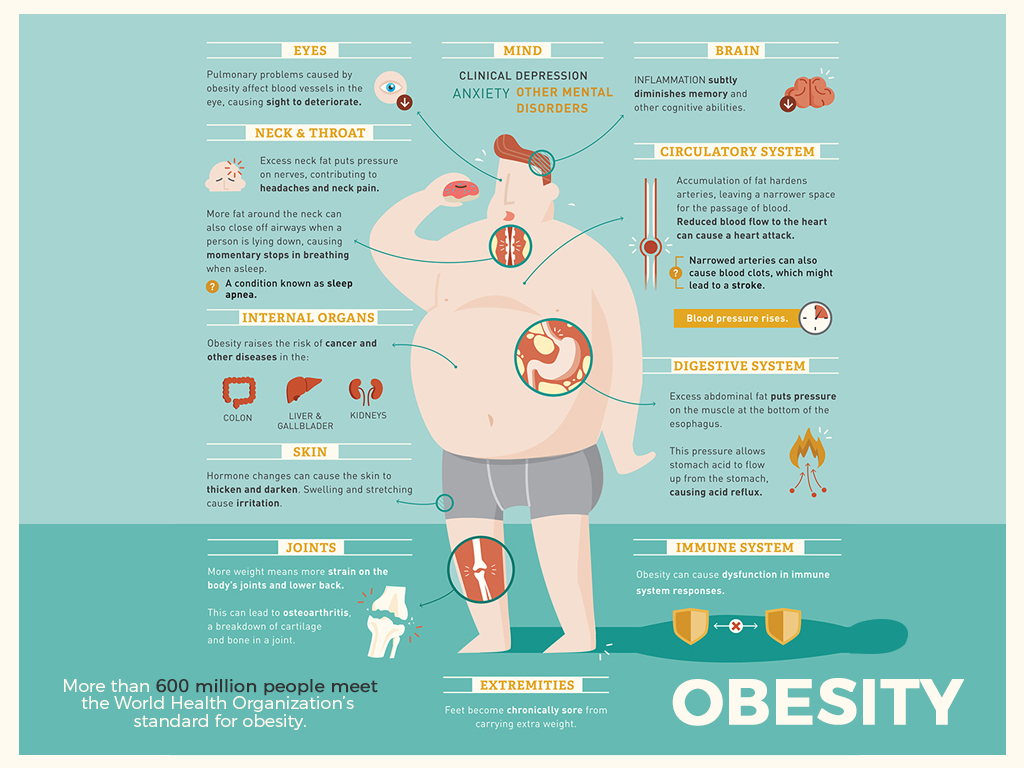 What is obesity? Is a medical condition that occurs when excess body fat has accumulated to the extent that it may negatively impact the health of the individual.