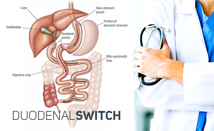 Bariatric Surgery Tijuana offers duodenal switch surgery for individuals with body mass index (BMI) of 50 or greater.