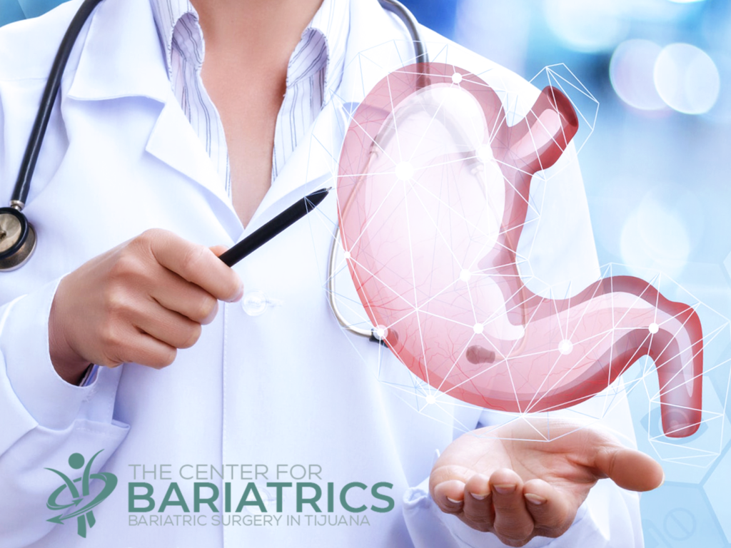 Gastric bypass, also called Roux-en-Y (roo-en-wy) gastric bypass, at Bariatric Surgery Tijuana, is a type of weight-loss surgery