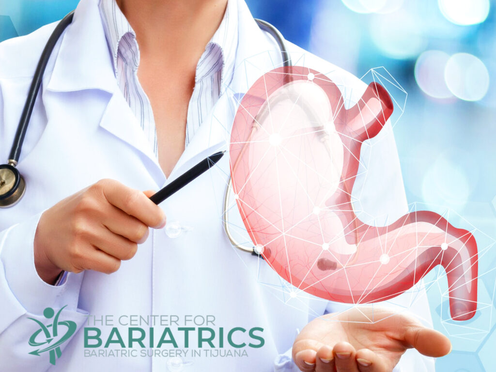 As the leaders in bariatric surgery in Tijuana. The Center for Bariatrics offers comprehensive weight loss surgery in Mexico.